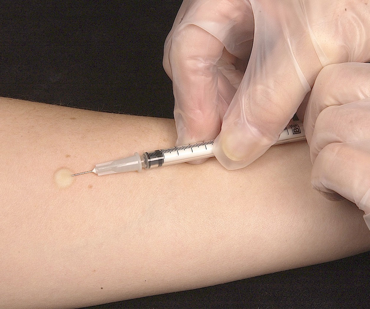 Aumentan casosde tuberculosis Aumentan casosde tuberculosis