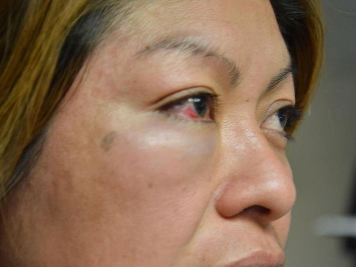 Acusa a exmarido por lesionarla en el rostro Acusa a exmarido por lesionarla en el rostro