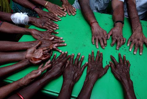 Disminuyen casos de lepra en México Disminuyen casos de lepra en México