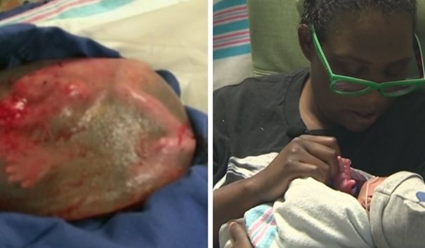 Sorprende nacimiento de bebé en saco amniótico