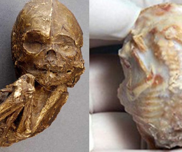Descubren feto momificado en una anciana de 91 años