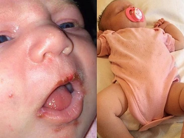 No deje que la gente bese a su bebé: Una madre comparte una foto impactante No deje que la gente bese a su bebé: Una madre comparte una foto impactante