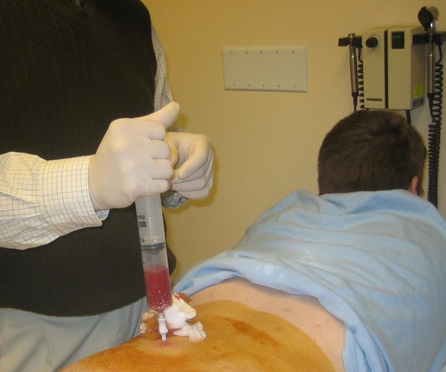 Trasplante, único medio contra cáncer de médula ósea