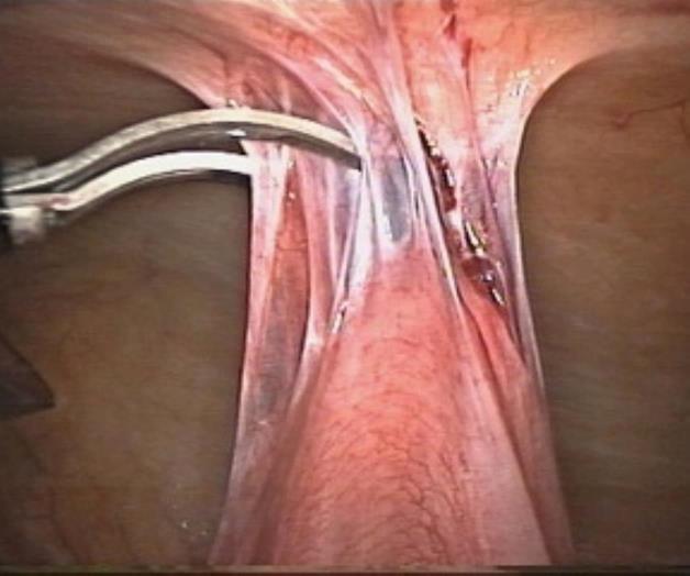 IPN desarrolla producto para evitar adherencias post quirúrgicas