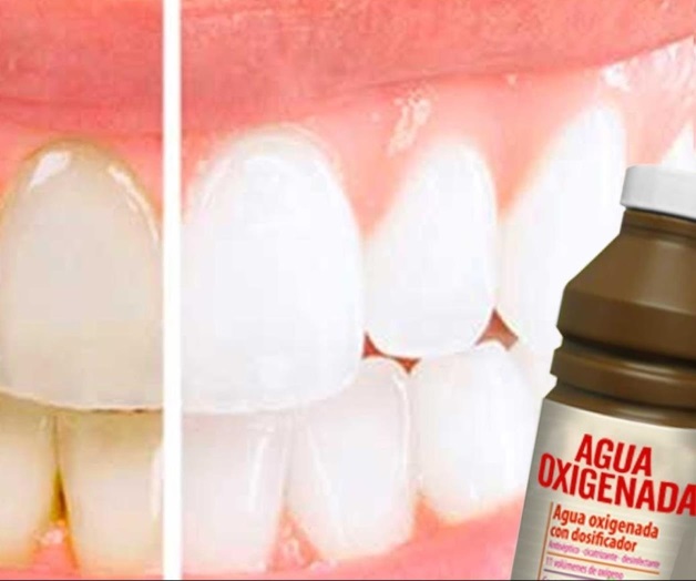 Agua oxigenada para blanquear dientes ocasiona daños en la salud Agua oxigenada para blanquear dientes ocasiona daños en la salud