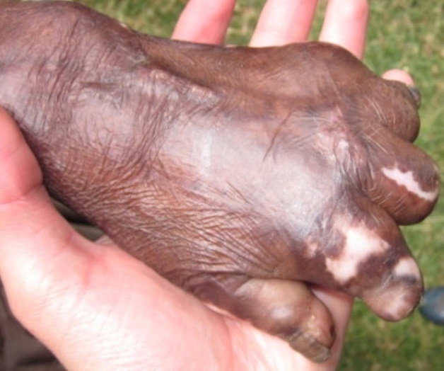 Lepra, enfermedad de la pobreza. En México no se ha erradicado