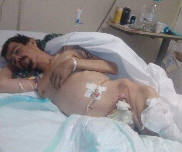 Piden apoyo para afectado por grangrena de Fournier