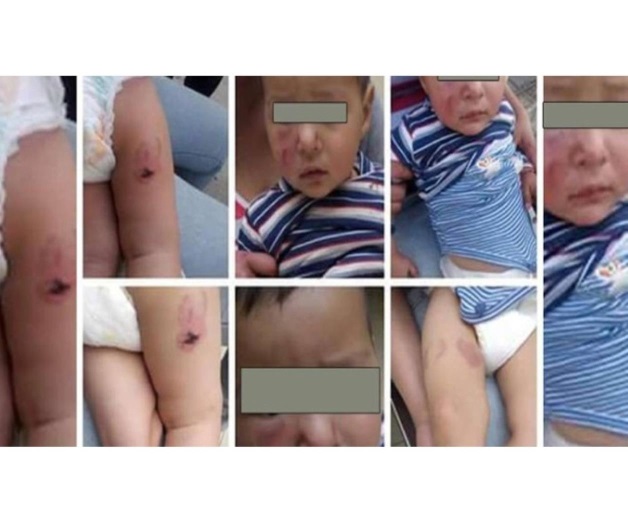 Bebé recibió 16 mordidas en cara, brazos y piernas