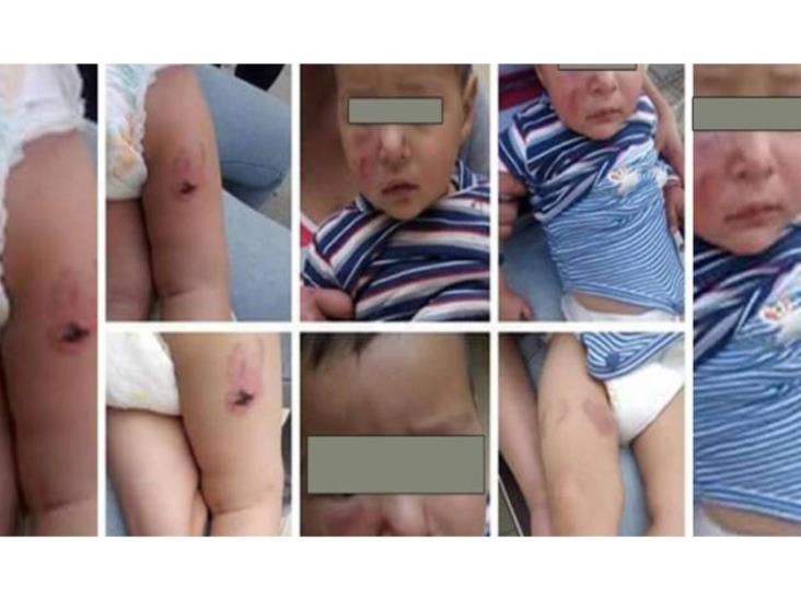 Bebé recibió 16 mordidas en cara, brazos y piernas Bebé recibió 16 mordidas en cara, brazos y piernas