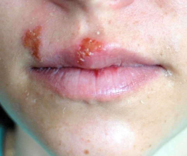 Causa virus los ‘fuegos’ labiales