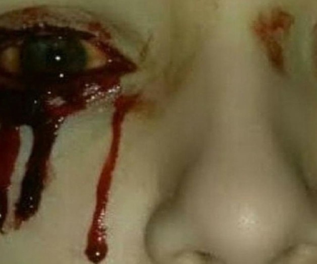 Joven llora sangre y los médicos desconocen la causa