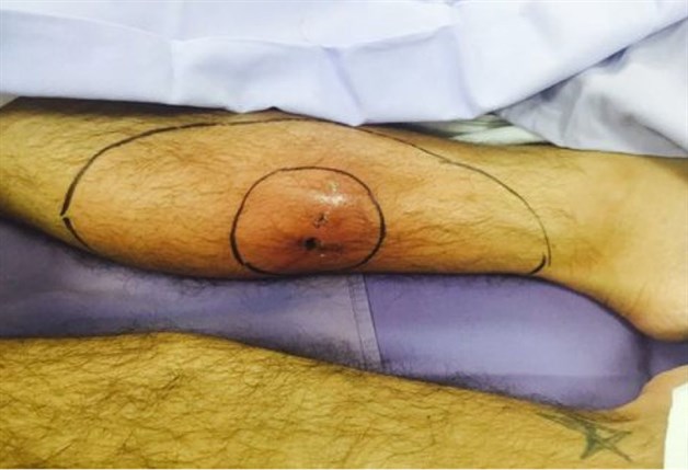 Intervenido por gangrena