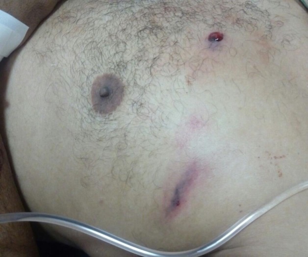 Recibe 5 tiros a ‘quemarropa’ con una pistola de balines