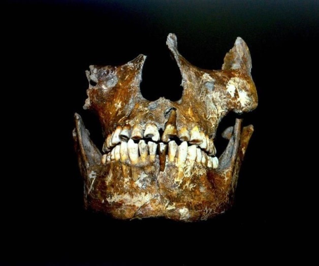 Revelan endodoncia más antigua del mundo Revelan endodoncia más antigua del mundo