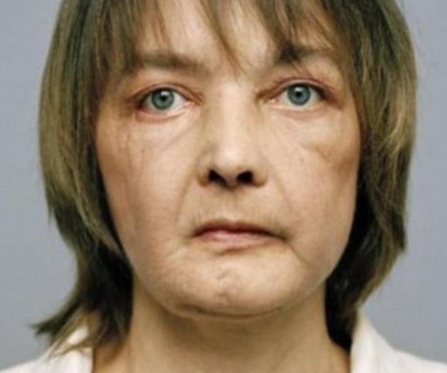Fallece primera mujer operada de cara en el mundo