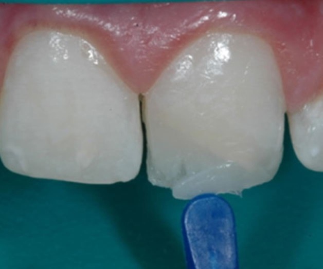 Científicos crean resinas dentales orgánicas de bajo costo