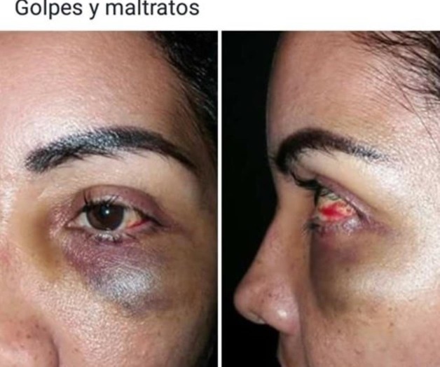 Se muestra golpeada esposa de Secretario de Gobierno de Veracruz Se muestra golpeada esposa de Secretario de Gobierno de Veracruz