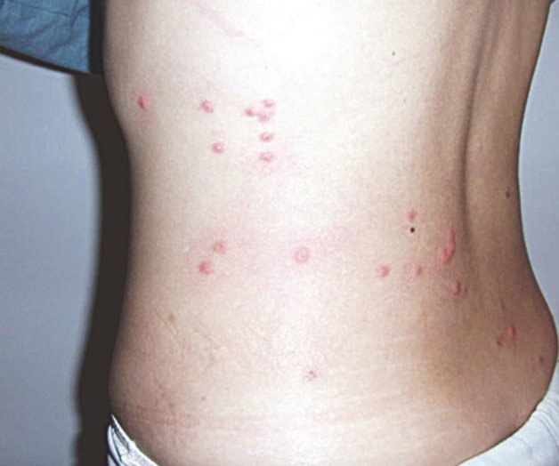 Tifus en Laredo, Tx.; alertan a la población. Autoridades de Salud a la expectativa Tifus en Laredo, Tx.; alertan a la población. Autoridades de Salud a la expectativa