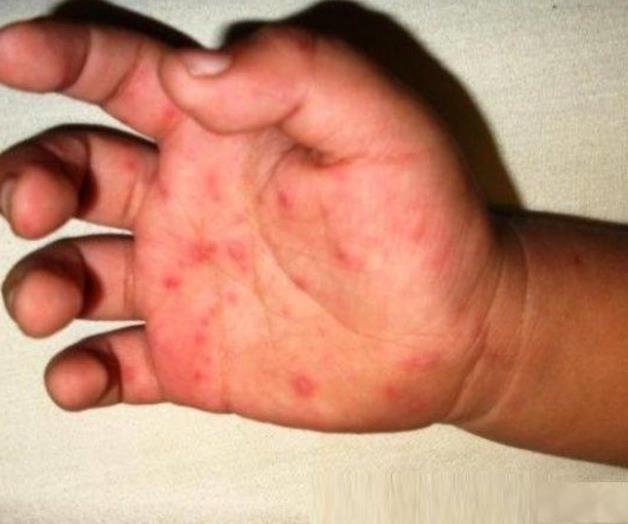 Preocupan casos de virus coxsackie Preocupan casos de virus coxsackie