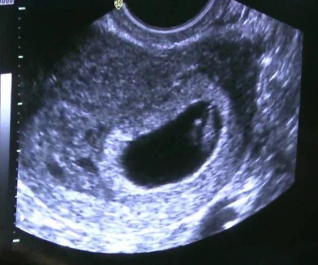 Ofrecen sonogramas gratis a embarazadas