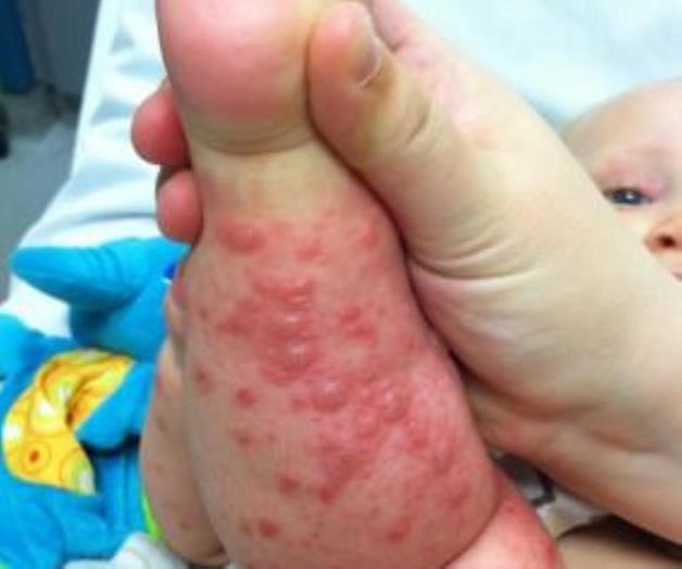 Alerta a padres sobre el virus coxsackie Alerta a padres sobre el virus coxsackie
