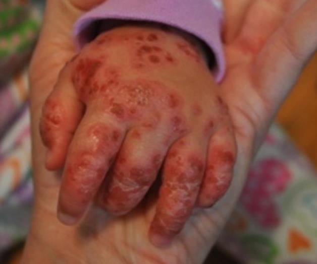 Orienta sobre el virus del coxsakie. Enfermedad de ‘Manos, pies y boca’