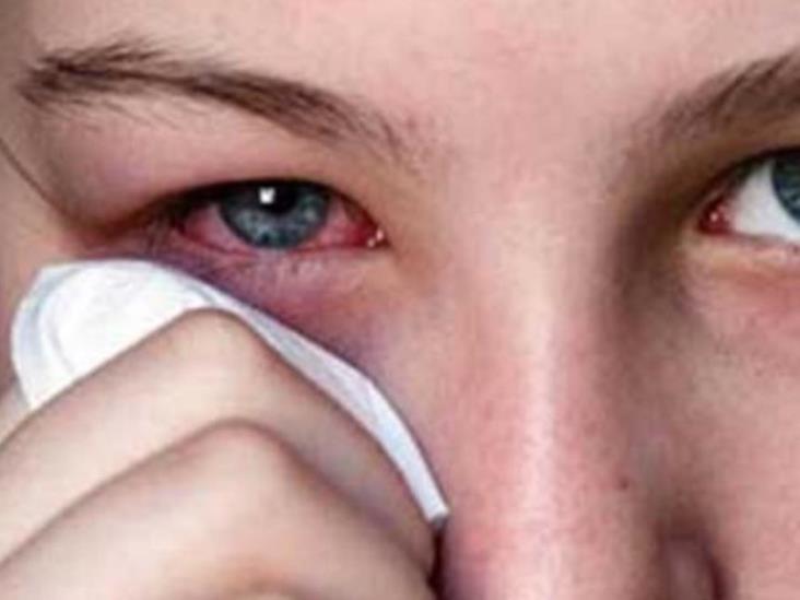 Reportan brote de conjuntivitis en Yucatán Reportan brote de conjuntivitis en Yucatán