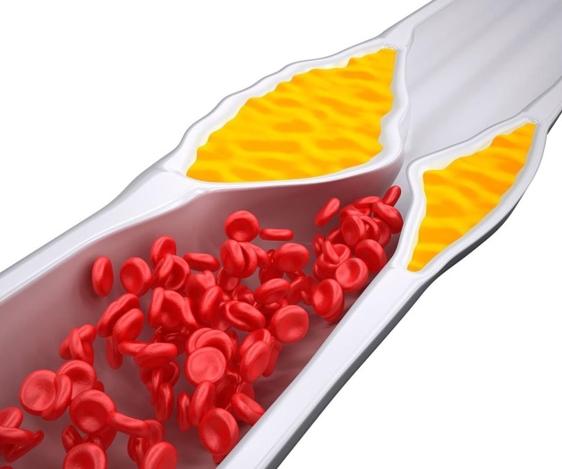 ¿Cómo reducir el colesterol malo? ¿Cómo reducir el colesterol malo?