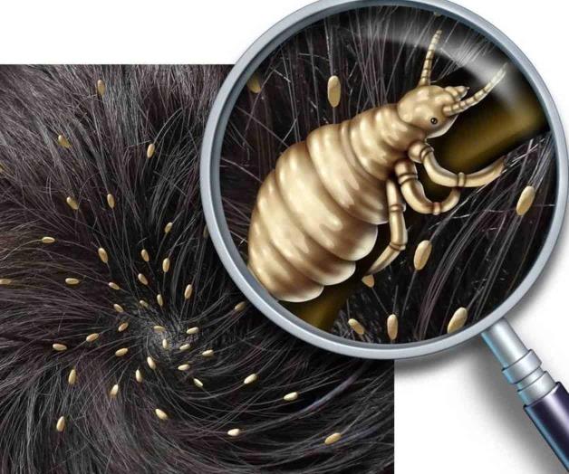 Aumentan en invierno casos de pediculosis. Piden redoblar esfuerzos en higiene