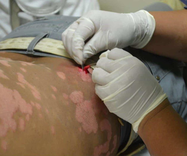 Van por eliminación de la lepra en 2018. Jurisdicción Sanitaria IV Van por eliminación de la lepra en 2018. Jurisdicción Sanitaria IV