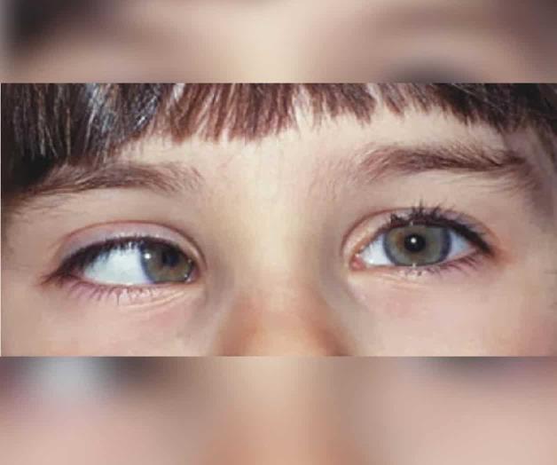 Convocan a redondear para atender estrabismo Convocan a redondear para atender estrabismo