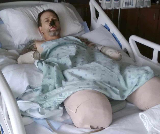 Sufre múltiples amputaciones por lamida de perro Sufre múltiples amputaciones por lamida de perro