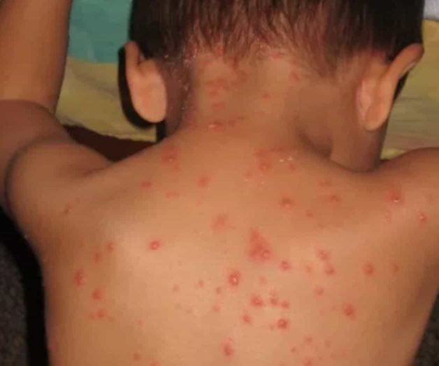 Afecta varicela a 430 niños en Nuevo Laredo Afecta varicela a 430 niños en Nuevo Laredo