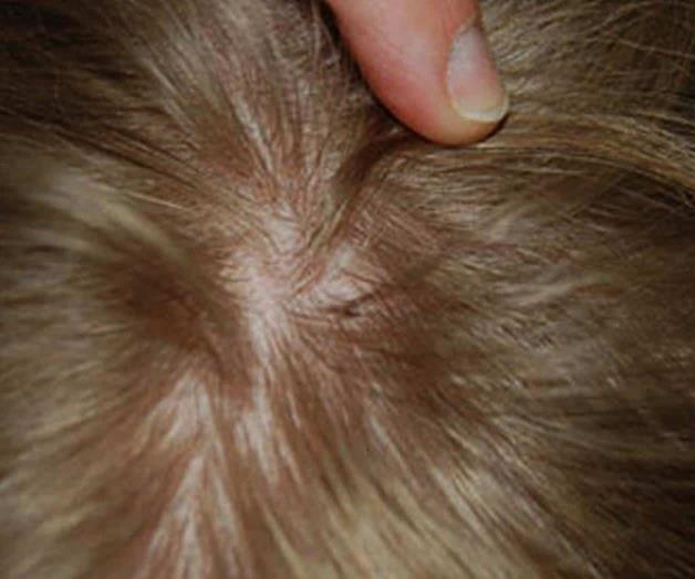 Detectan piojos en los alumnos; temen plaga Detectan piojos en los alumnos; temen plaga