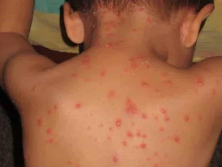 Alerta incremento de casos de varicela en Yucatán Alerta incremento de casos de varicela en Yucatán