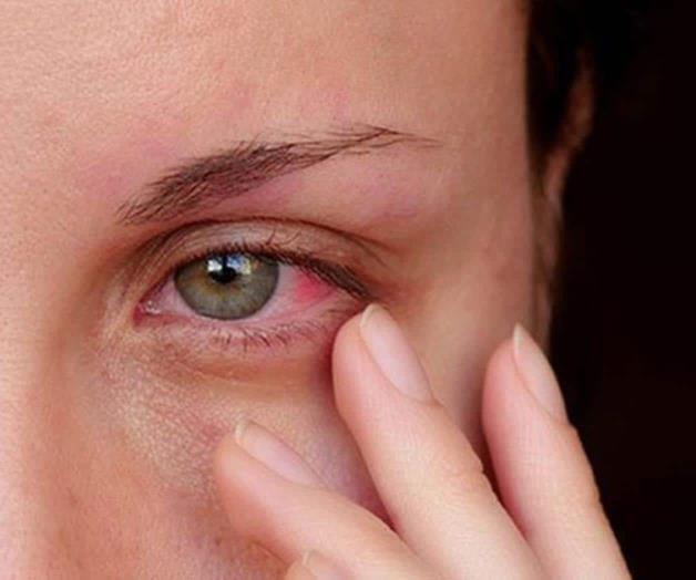 Expertos descartan que derrame ocular cause problemas de visión Expertos descartan que derrame ocular cause problemas de visión