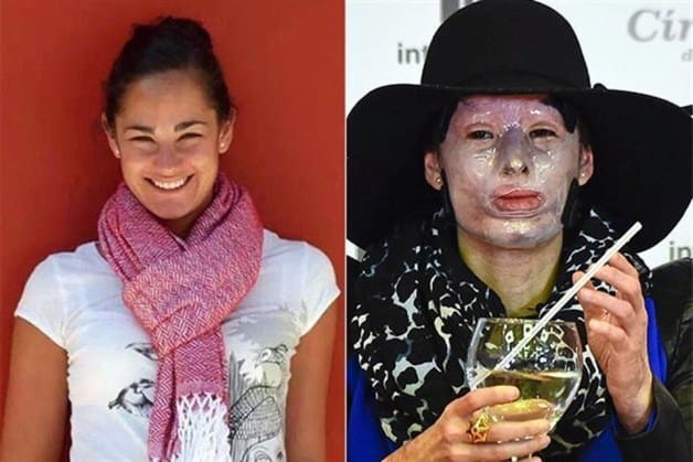 Activista: ataque con ácido es morir en vida Activista: ataque con ácido es morir en vida