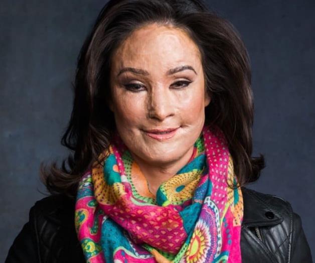 Activista: ataque con ácido es morir en vida Activista: ataque con ácido es morir en vida