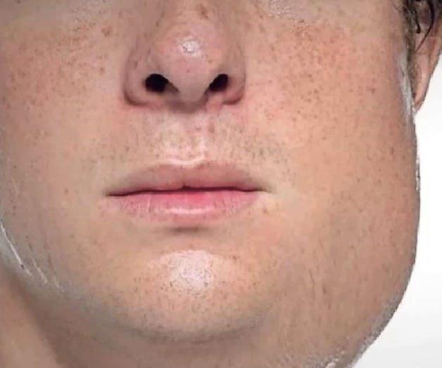 Confirman caso de paperas en Mission