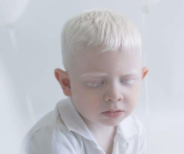 Personas con albinismo presentan afectación en piel, cabello y ojos Personas con albinismo presentan afectación en piel, cabello y ojos