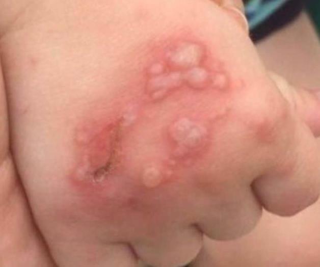 Descartan en Reynosa haya casos de coxsackie