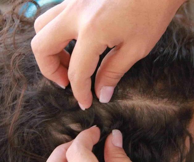 Si hay contagio de piojos, es mejor ir al médico Si hay contagio de piojos, es mejor ir al médico