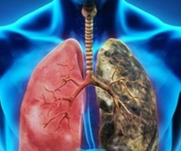 En México, tratar cáncer de pulmón es ocho veces más caro que el de mama