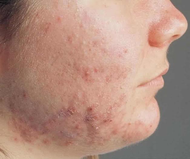 Remedios caseros agravan cuadro clínico de acné especialista Remedios caseros agravan cuadro clínico de acné especialista