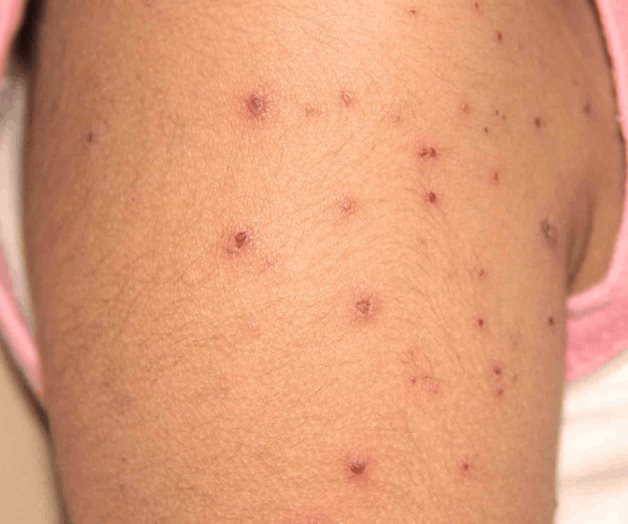 Piden tener cuidado con enfermedad viral