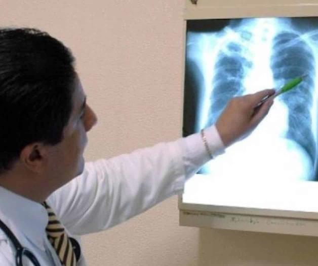 Detectan tuberculosis en pacientes con Covid-19 de Tampico Detectan tuberculosis en pacientes con Covid-19 de Tampico