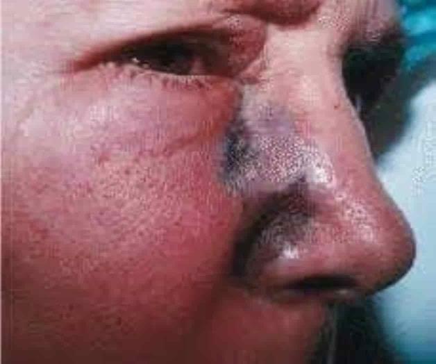 Descartan hongo negro en Valle Hermoso- Río Bravo Descartan hongo negro en Valle Hermoso- Río Bravo