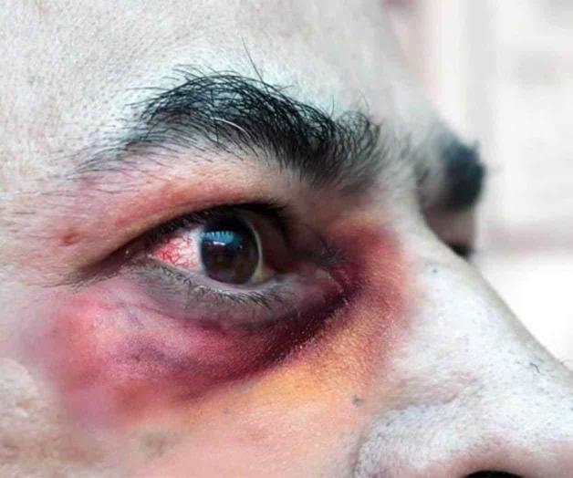 Descartan presencia del Hongo Negro Descartan presencia del Hongo Negro