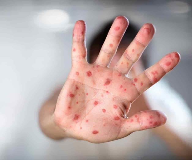 Viruela de los monos, una nueva amenaza Viruela de los monos, una nueva amenaza