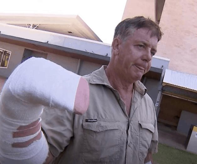 Australiano un poco adolorido después de que una mano quedó atrapada en las mandíbulas de un cocodrilo Australiano un poco adolorido después de que una mano quedó atrapada en las mandíbulas de un cocodrilo